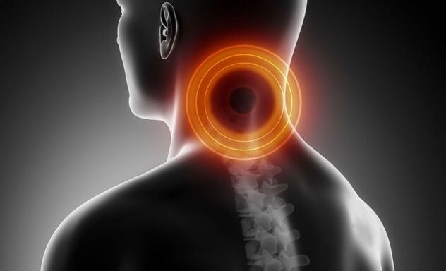 cervicalgia con osteocondrosi cervicale